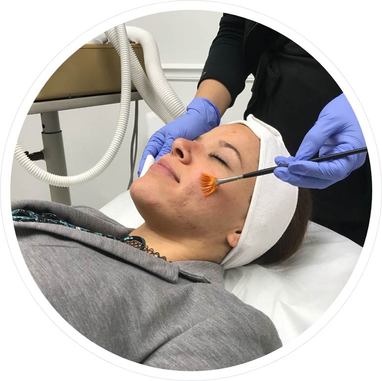 Acne Treatment by Laser