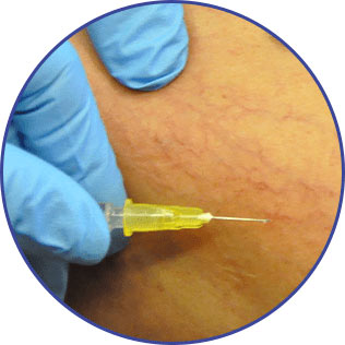 Instruction Injection Techniques Sclerotherapy