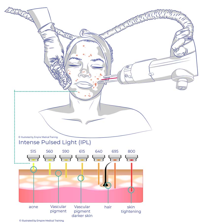Intense Pulse Light Acne Treatment