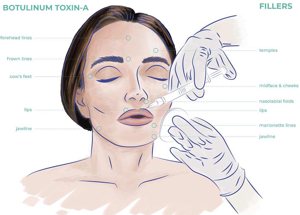 Advanced Botulinum Toxin-A Fillers Areas of Interest Face