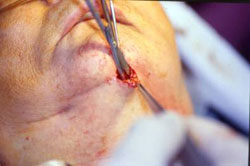 Submental Liposurgery Training