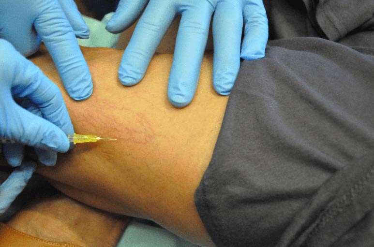 Sclerotherapy Training and Injection Techniques