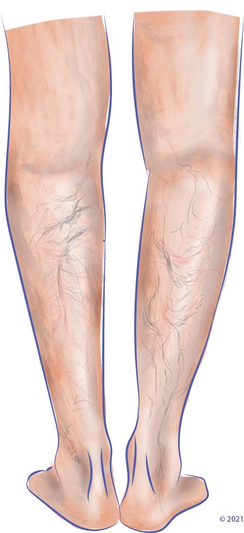 Sclerotherapy Training Injection Legs