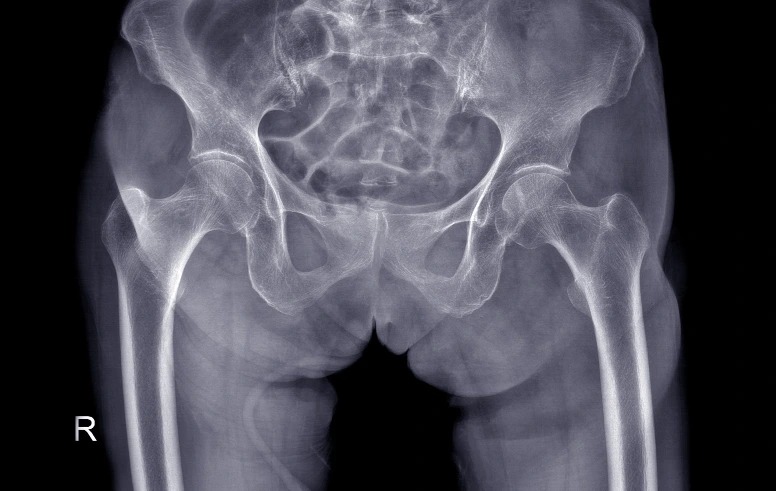X-ray of sacrolumbar region